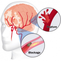 obat stroke batang otak
